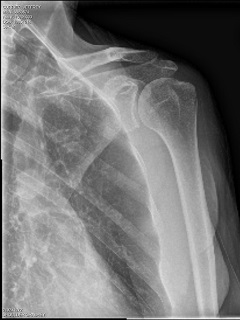 flyfishing-injuries