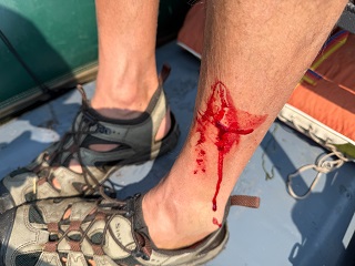 leech-bites
